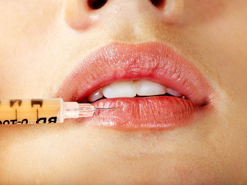 Lippenvergrößerung Dortmund - Bild eines weiblichen Gesichts mit vollen Lippen, Injektionsspritze an der Unterlippe